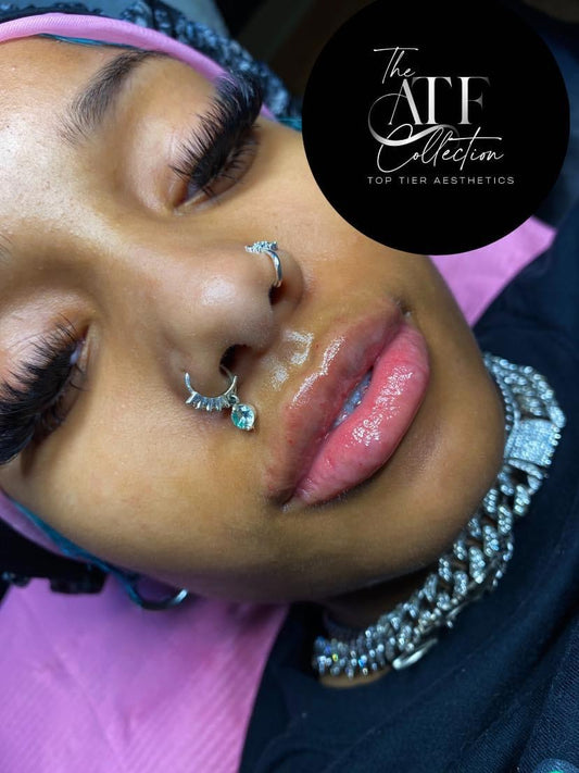 1.5 mL Lip Fillers